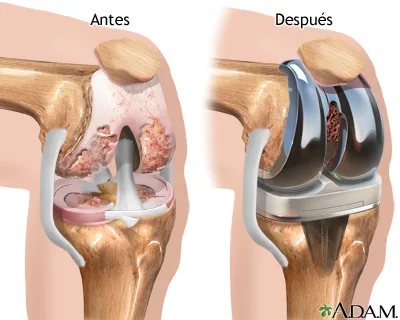 Reemplazo de rodilla: comparación antes y después de la artroplastia — articulación dañada vs. prótesis