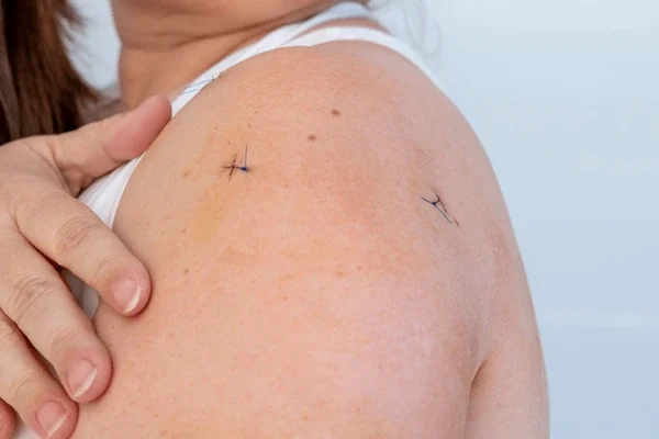 Hombro con dos pequeñas incisiones después de artroscopia — cicatrices mínimas de menos de 1 cm