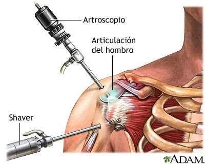 Diagrama de artroscopia de hombro: artroscopio y shaver introducidos en la articulación glenohumeral