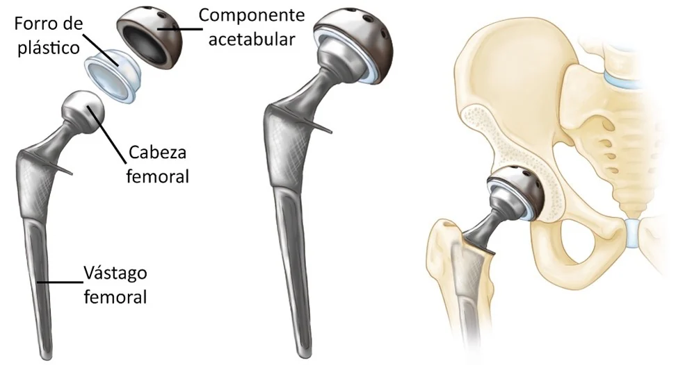 Componentes de la prótesis de cadera: vástago femoral, cabeza esférica y copa acetabular