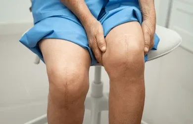 Paciente con cicatriz postoperatoria de reemplazo de rodilla — resultado típico tras artroplastia en Metepec
